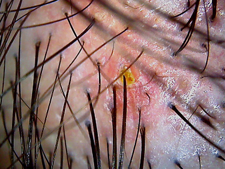 頭皮のトラブル 脂漏性皮膚炎から薄毛治療(AGA)とその効果 モッキーのお気楽アイテム出来事 頭皮のトラブル 脂漏性皮膚炎から薄毛治療(AGA)とその効果 モッキーのお気楽アイテム出来事