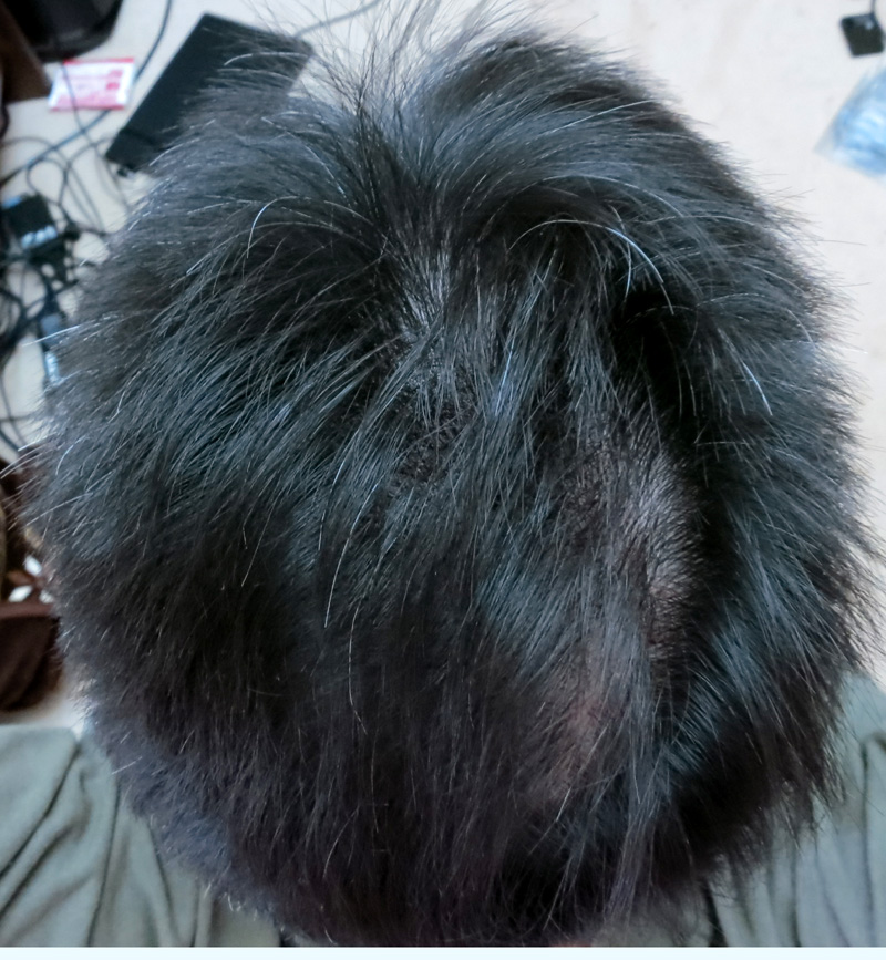 薄毛治療（AGA）　プロペシアを飲んで9ヶ月目の後頭部の写真