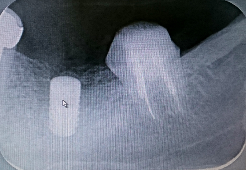 implant201705301.jpg
