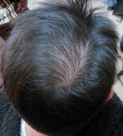 AGA男性型脱毛症治療を始めて5ヵ月後